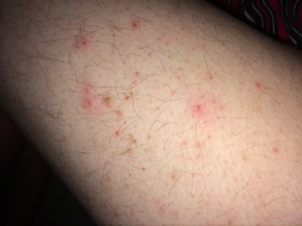 What Causes Pimples On My Thighs?